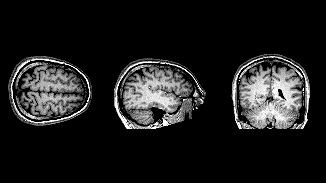 MRI Brain Scan
